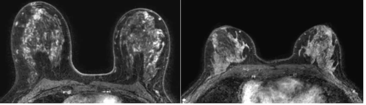 Can AI Automate BPE Assessment of Dense Breasts on MRI?