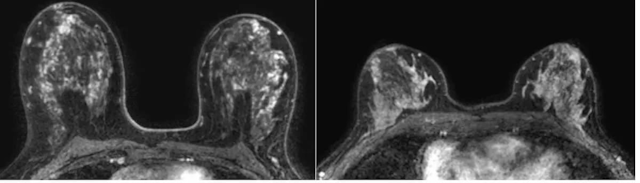 Can AI Automate BPE Assessment of Dense Breasts on MRI?