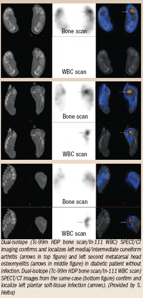 Dual-isotope SPECT/CT finds infections in diabetic feet