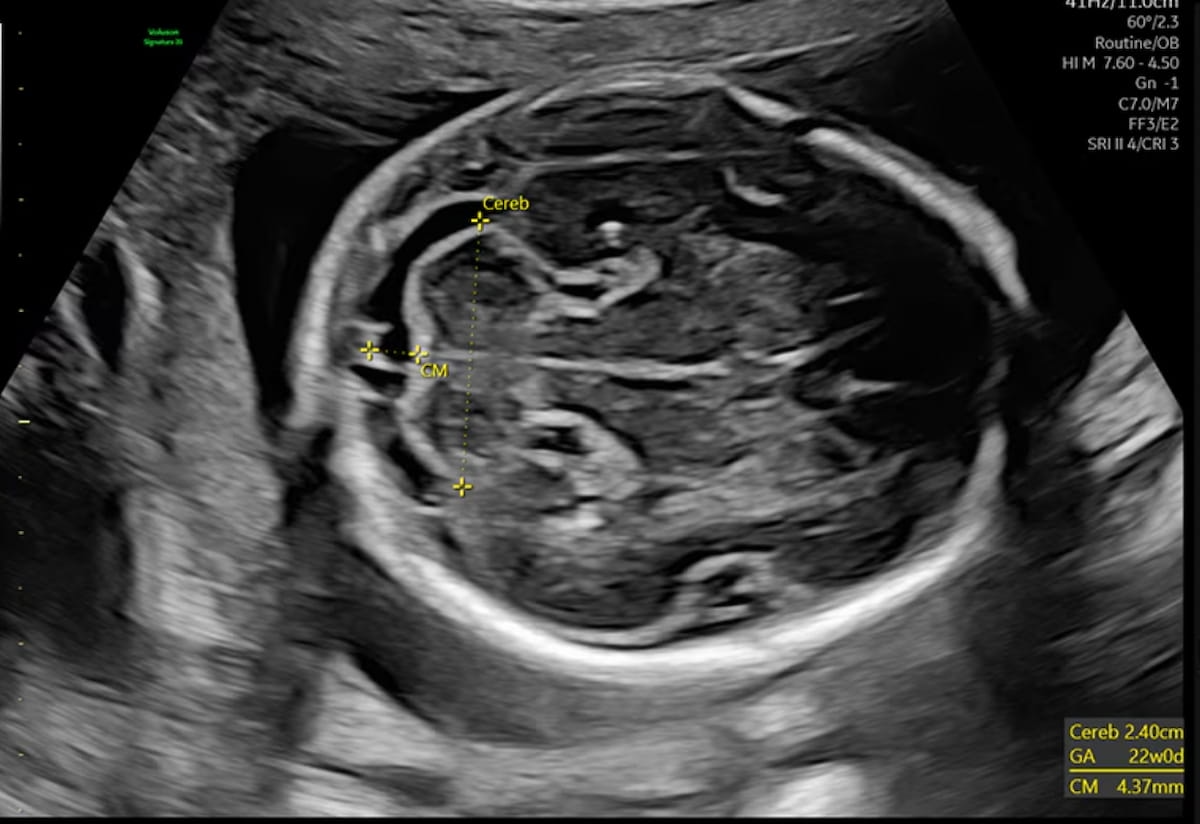 New AI-Powered Ultrasound Devices Enhance Efficiency in Women’s Health Imaging