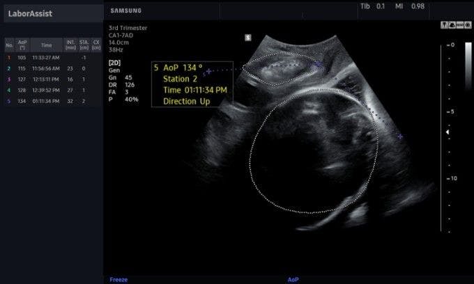Samsung-Intel AI Partnership Behind Fetal Ultrasound Smart Workflow