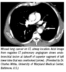 Patient survival influences new lung cancer staging system