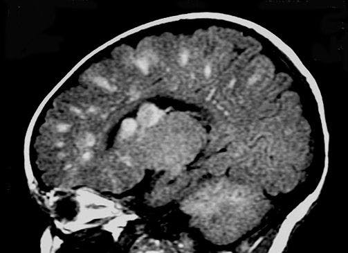 Image IQ Quiz: Young Patient Presents with Chronic Seizures