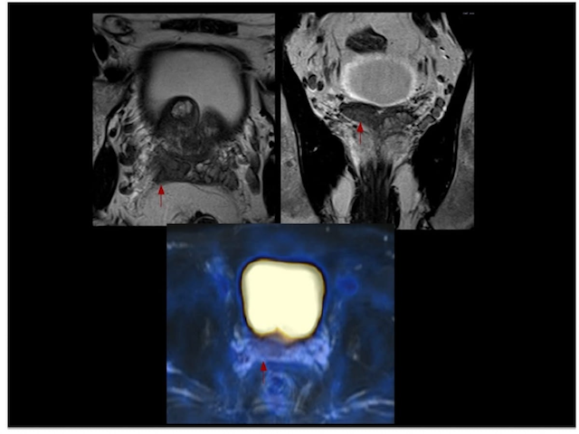 Study Shows PET MRI Offers Better Detection of Localized Prostate Cancer than mpMRI