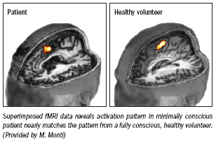 fMRI indicates cognition in unconscious patients