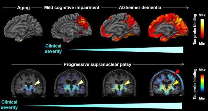 Radiotracer Improves Detection of Tau Accumulation in Patients with Dementia