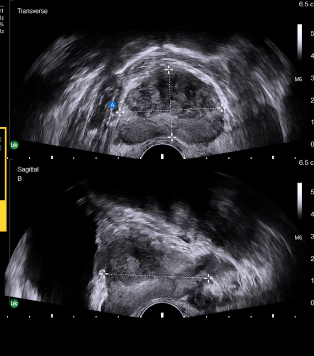 GE Healthcare Launches AI-Powered Prostate Volume Assist for Ultrasound
