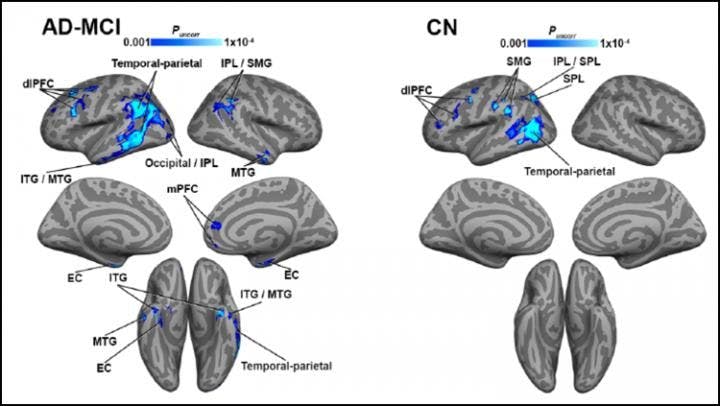 MRI and PET Reveal Link Between Blood Flow and Tau Accumulation in Alzheimer’s Patients