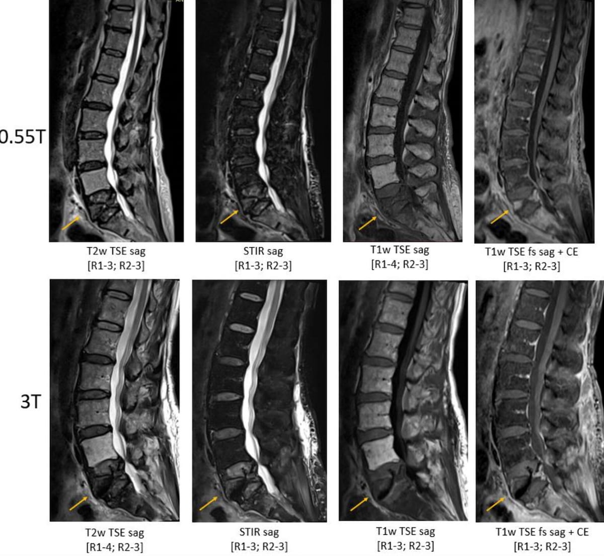 Study Says Low-Field MRI Offers Sufficient Diagnostic Quality for Detecting Spinal Pathology