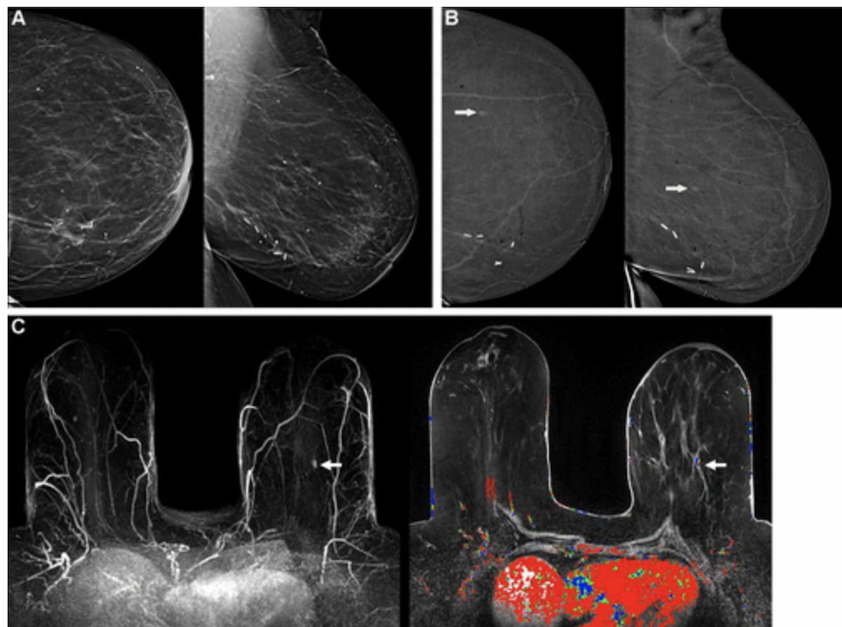 Can Contrast-Enhanced Mammography Enhance Early Detection in Patients with Prior Breast Cancer History?