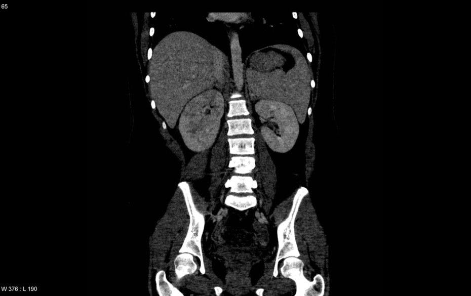 Image IQ Quiz: Patient Presents with Fever and Abdominal Pain