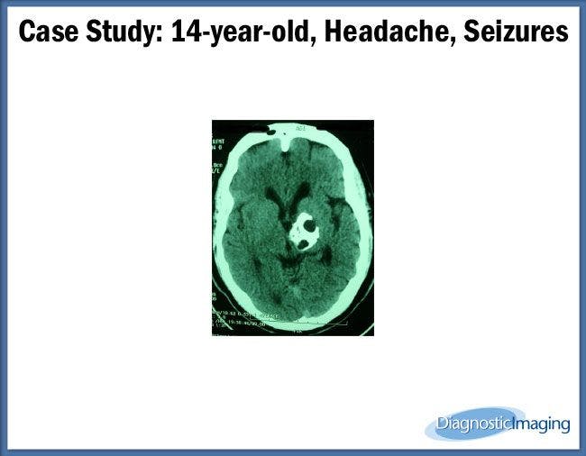 14-year-old, Headache, Seizures