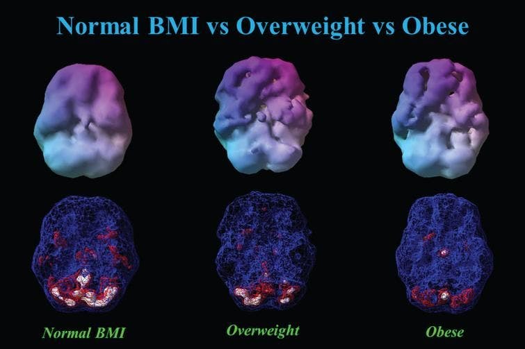 SPECT Scan Reveal Link Between Obesity, Brain Blood Flow, and Alzheimer’s