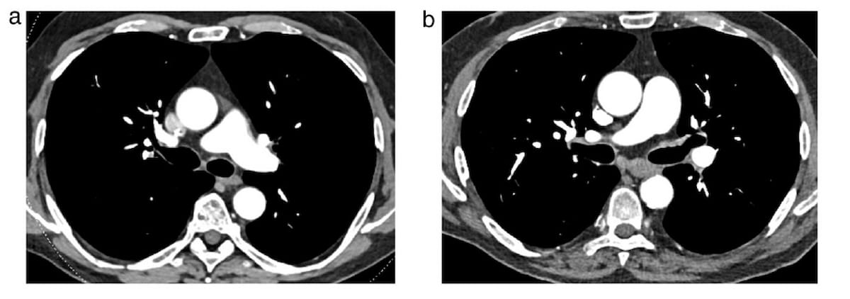 Study Reveals Benefits of Photon-Counting CT for Assessing Acute Pulmonary Embolism
