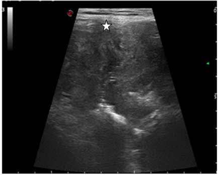 Malignant Supravesical  Mass in Urachal Remnant