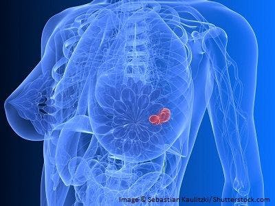Study: False-Positive Breast Biopsies Cost $2 Billion Annually