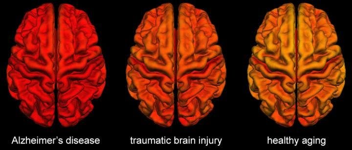MRI Brain Scans Show Similarities Between TBI and Alzheimer’s