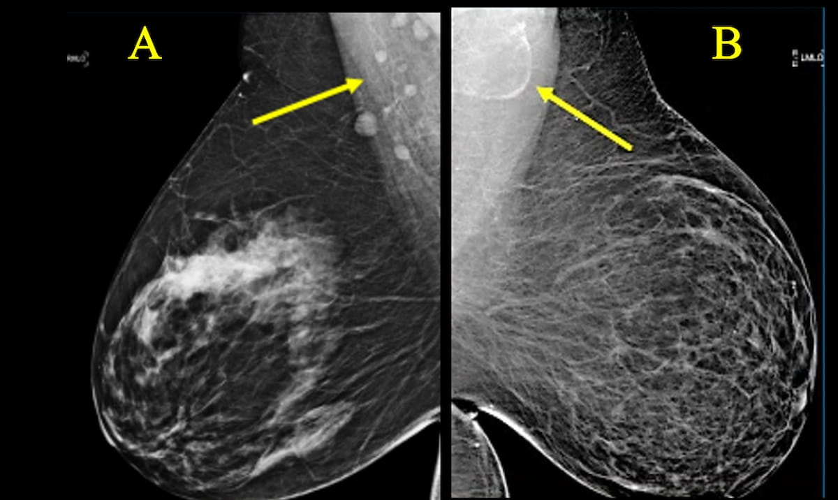 Mammography Study Shows Link Between Enlarged Axillary Lymph Nodes and Higher Risks for Diabetes and Cardiovascular Disease
