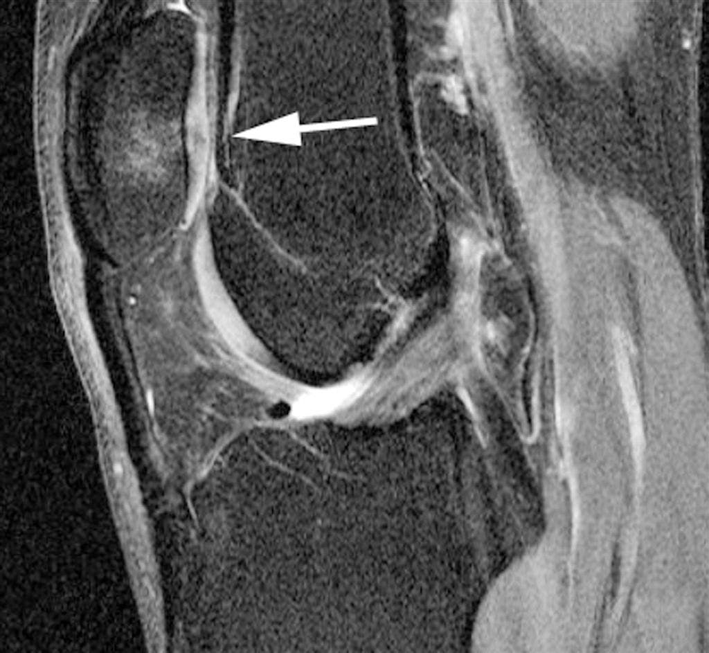3T MRI unveils links between physical exertion, osteoarthritis