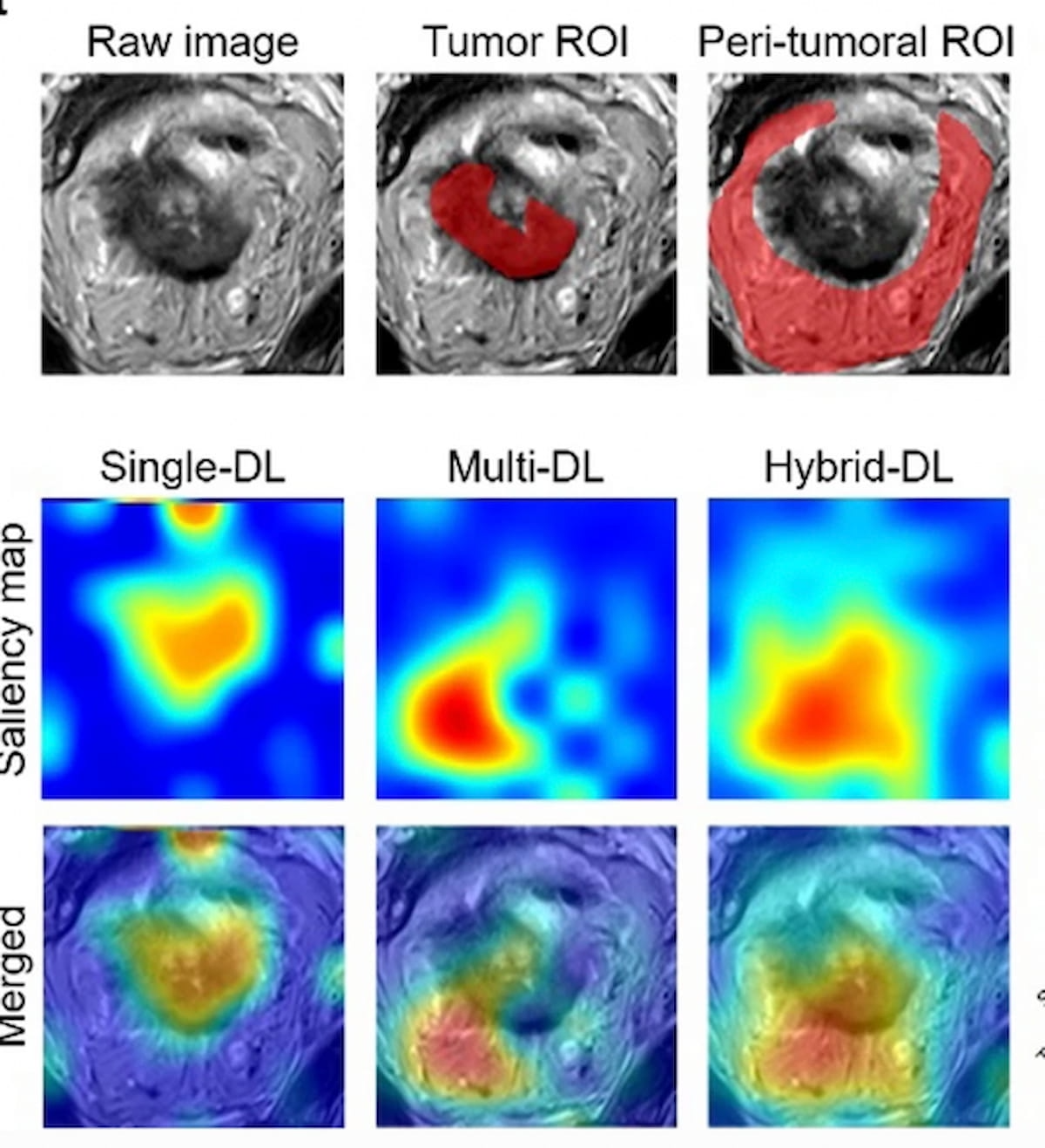 Hybrid MRI Deep Learning Model Shows Promise in Predicting Tumor Deposits with Rectal Cancer
