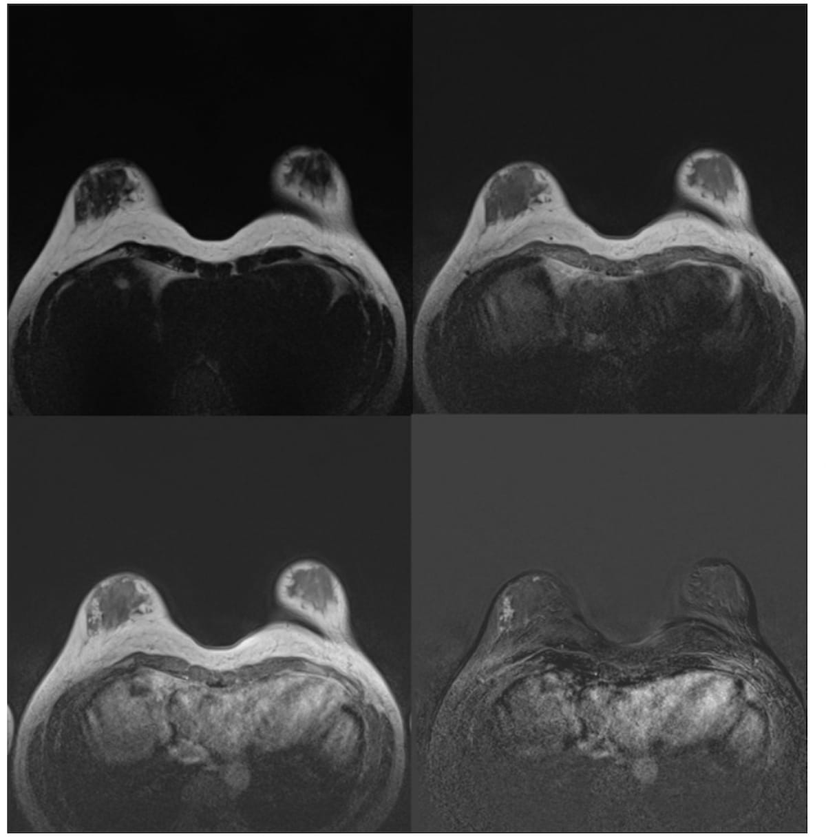 Breast MRI and Dense Breasts: A Closer Look at Early Findings from a New Prospective Trial 
