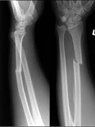 Don’t Rely on X-rays to Determine Forearm Fracture Treatment