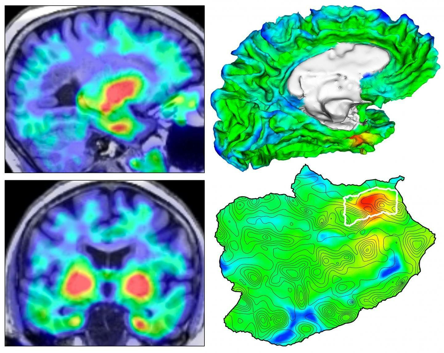 PET Imaging Reveals Site of Tau’s Emergence in Alzheimer’s
