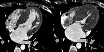 Imaging’s role increases in diagnosis of cardiomyopathies