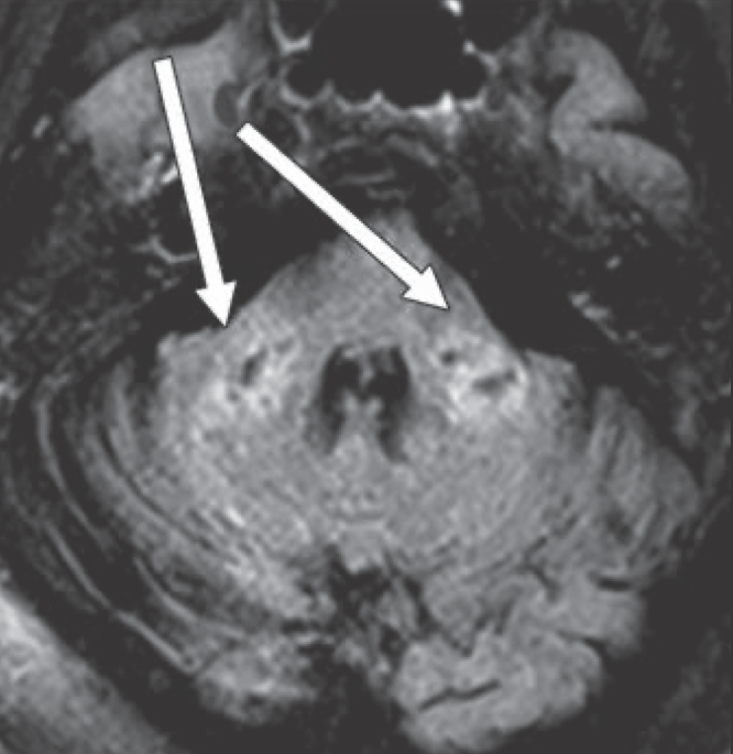 Brain MRI Reveals Leukoencephalopathy Vulnerability in COVID-19 Patients