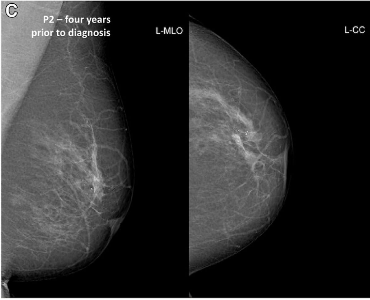 Mammography Study: AI Software Predicts One-Third of Breast Cancer Cases Up to Two Years Prior to Diagnosis