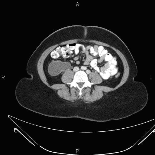 An unusual cause for hydronephrosis