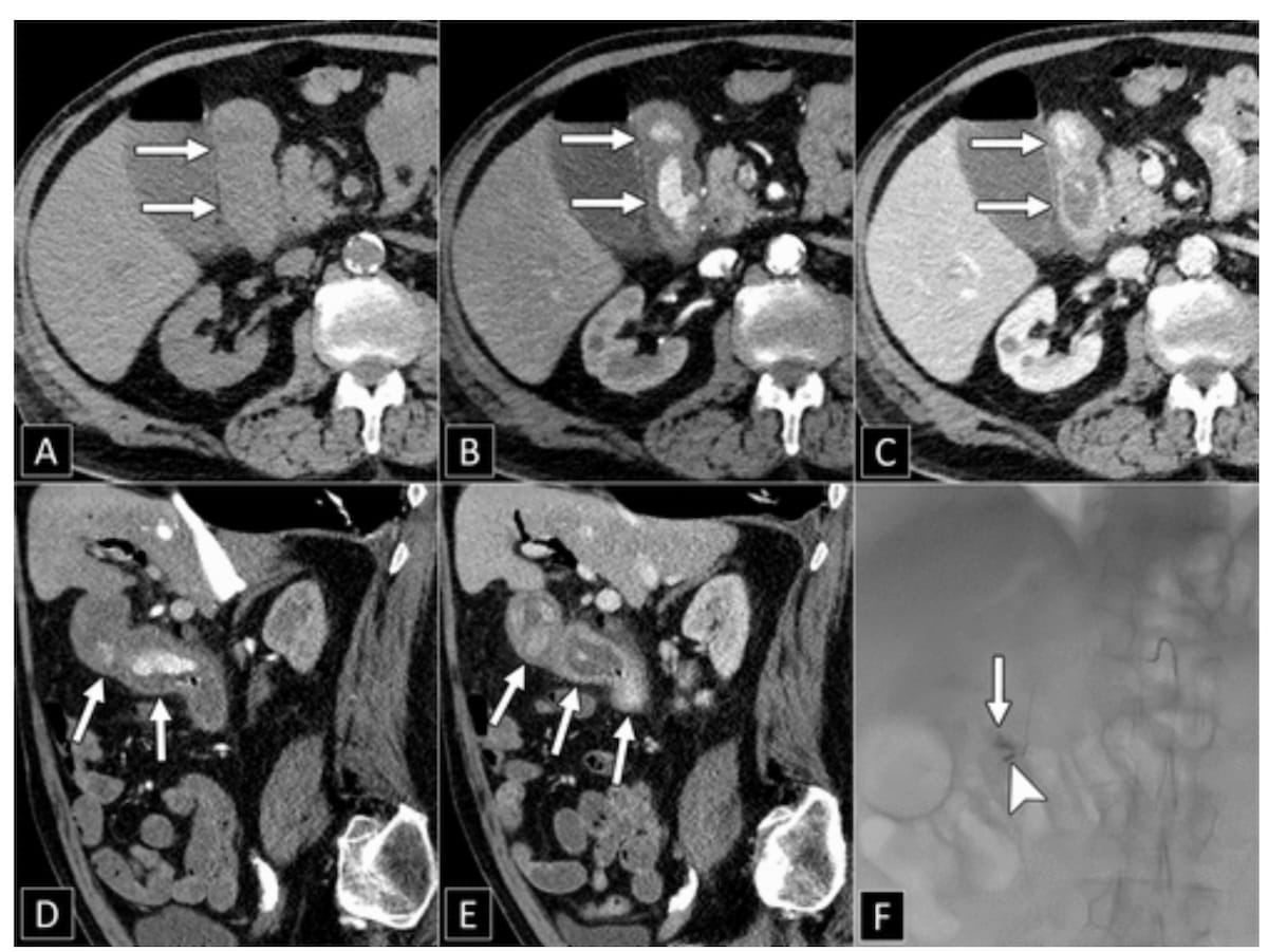 Computed Tomography Insights on GI Bleeding: Nine Takeaways from New Consensus Recommendations