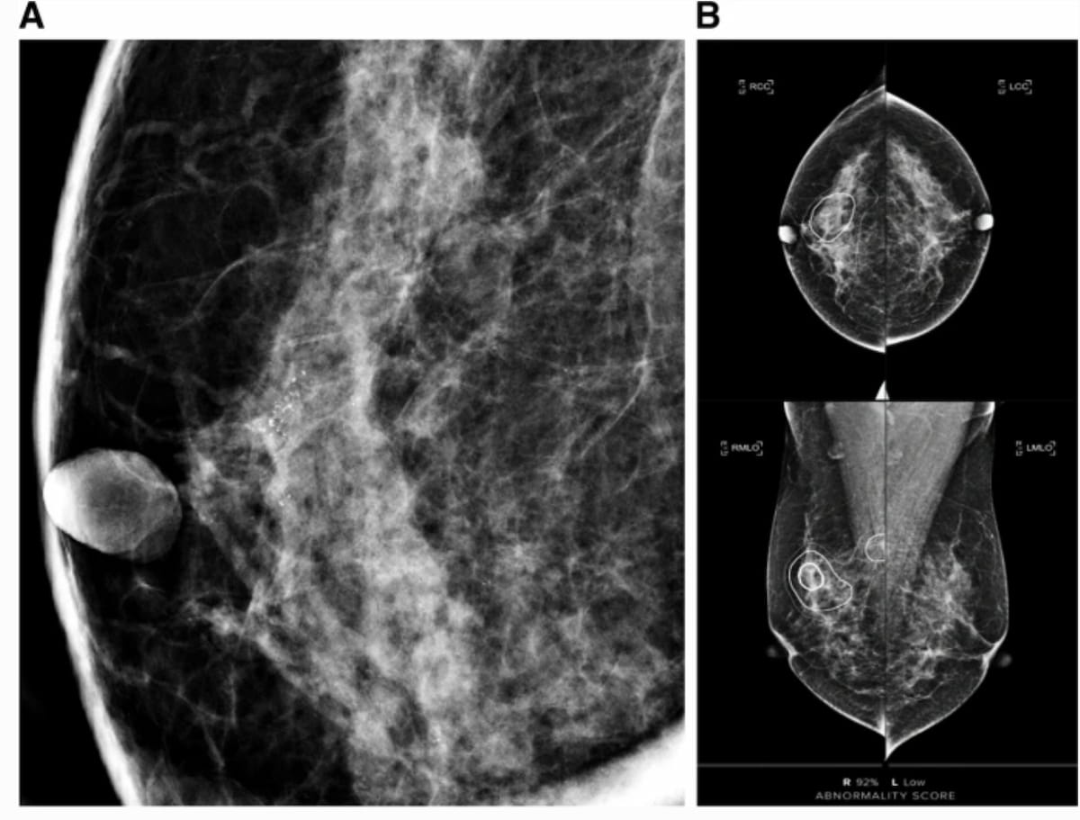 Mammography-Based AI Abnormality Scoring May Improve Prediction of Invasive Upgrade of DCIS