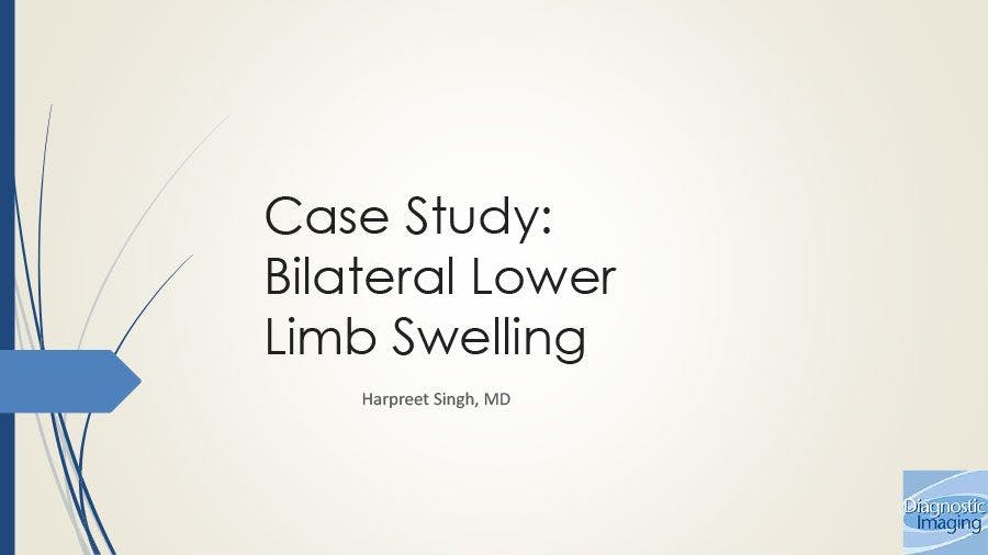 Bilateral Lower Limb Swelling