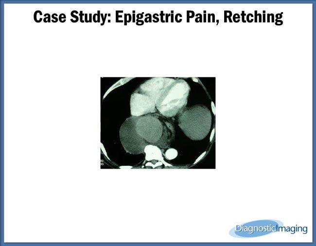 Epigastric Pain, Retching