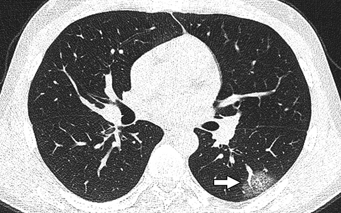 Chest CT Accurate in Estimating All-Cause COPD Mortality Risk