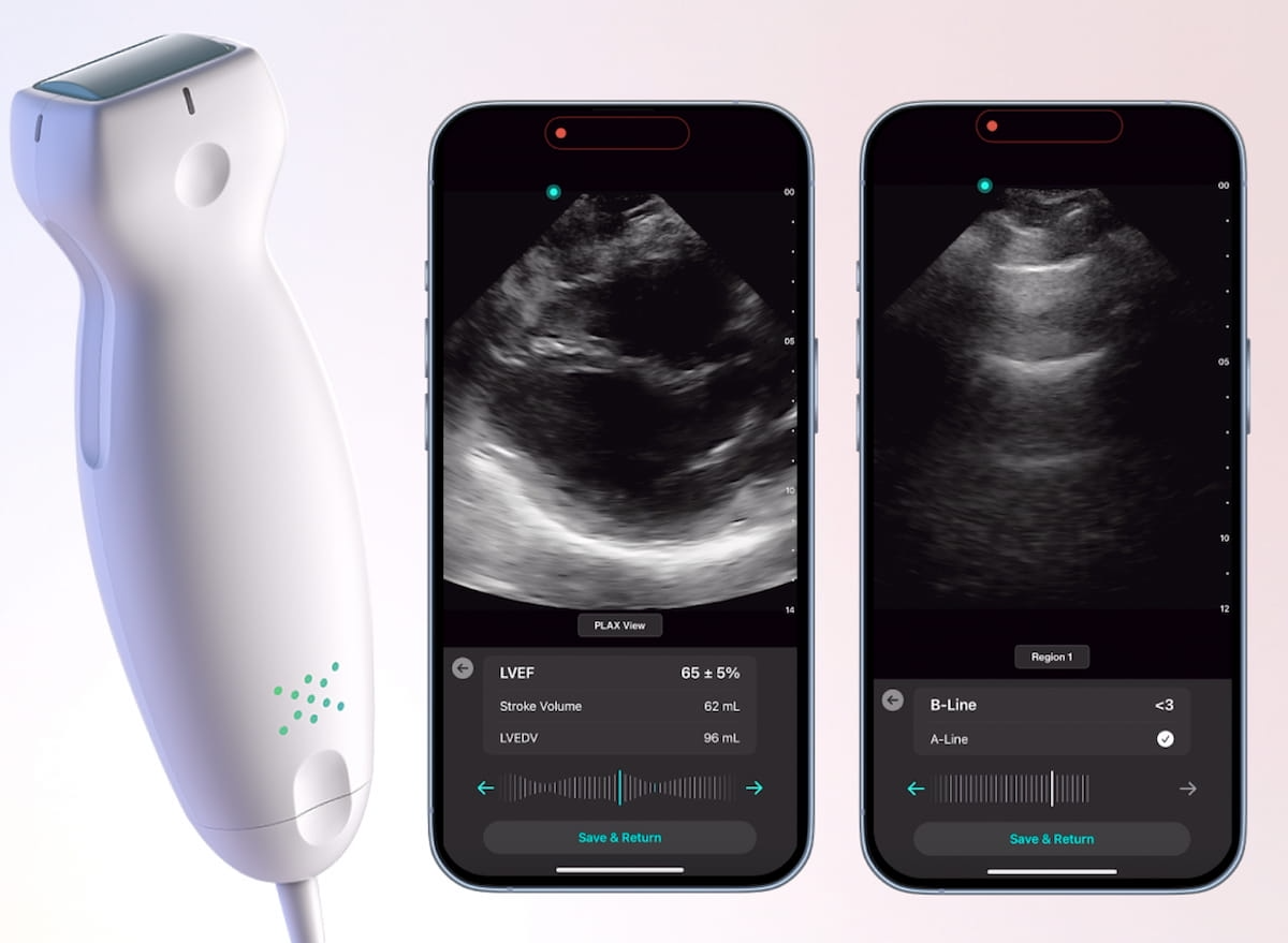 FDA Clears Cardiac and Lung AI Applications for Exo Iris Handheld Ultrasound