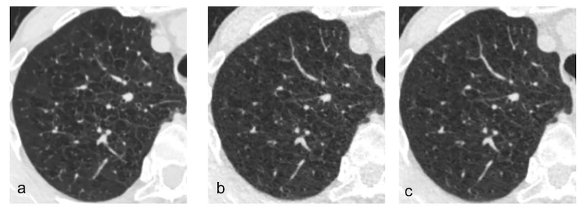 Can Deep Learning Bolster Image Quality with Low-Dose Lung CT?