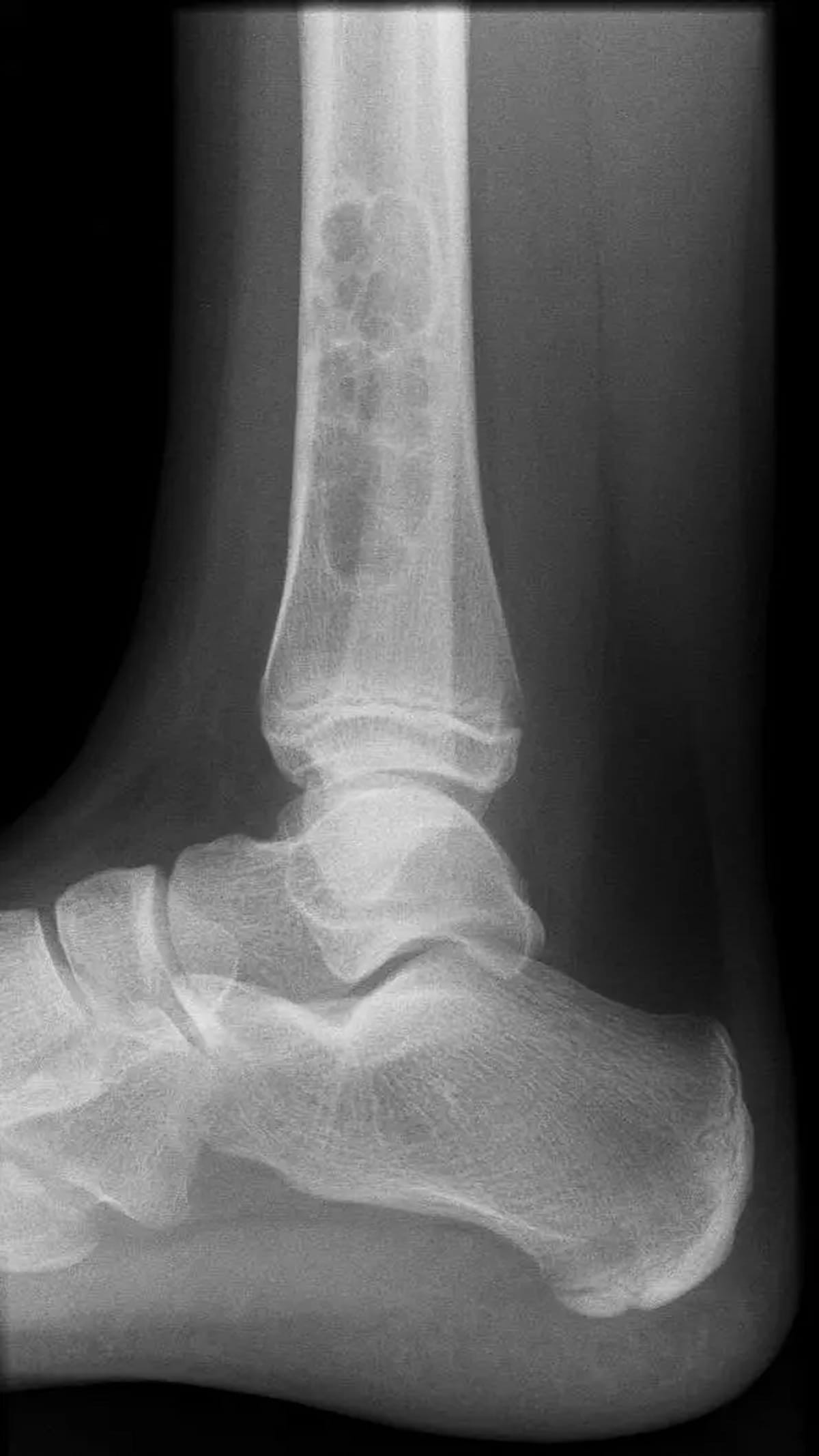 Image IQ Quiz: Pediatric Patient with Lower Extremity Pain and Lesion in Long Bone Metaphysis