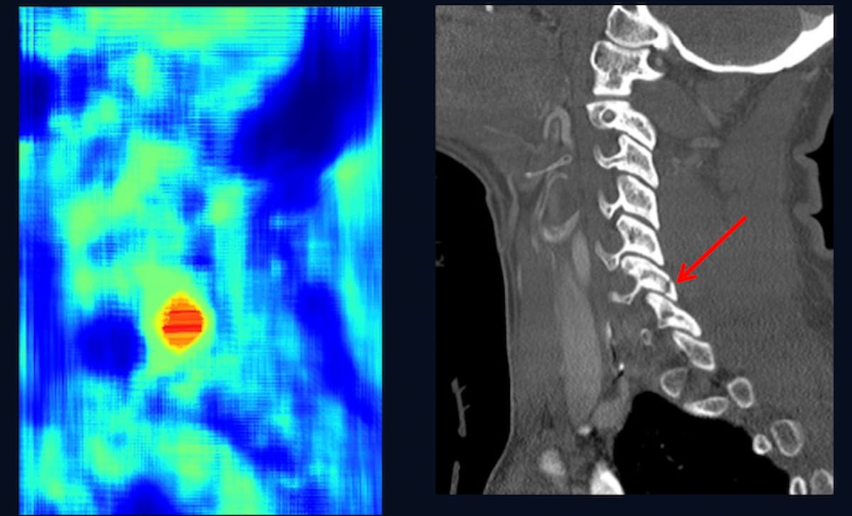Study Finds High Concordance Between AI and Radiologists for Cervical Spine Fractures on CT