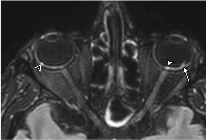 Windows of Infection: MRI Reveals COVID-19-Linked Eye Abnormalities