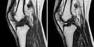 MRI Data Suggest Quadricep Tissue Grafts Superior for ACL Repair