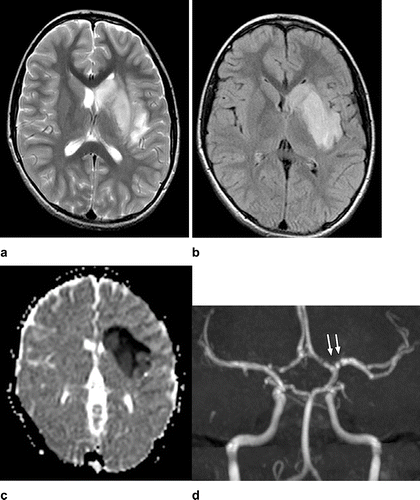 MRI Shows Pediatric Stroke Case Associated with COVID-19