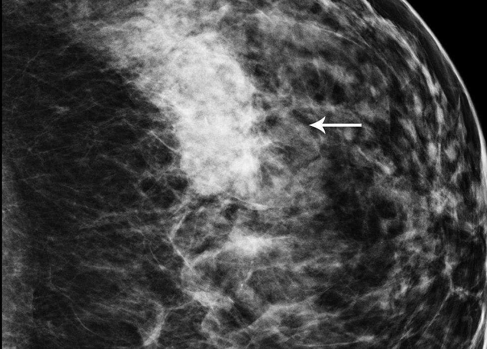Image IQ: 42-year-old with Architectural Distortion on Breast Tomo