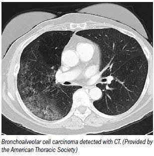 CT not yet winning support for lung cancer screening