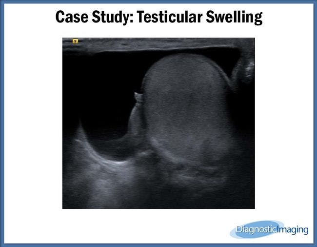 Testicular Swelling