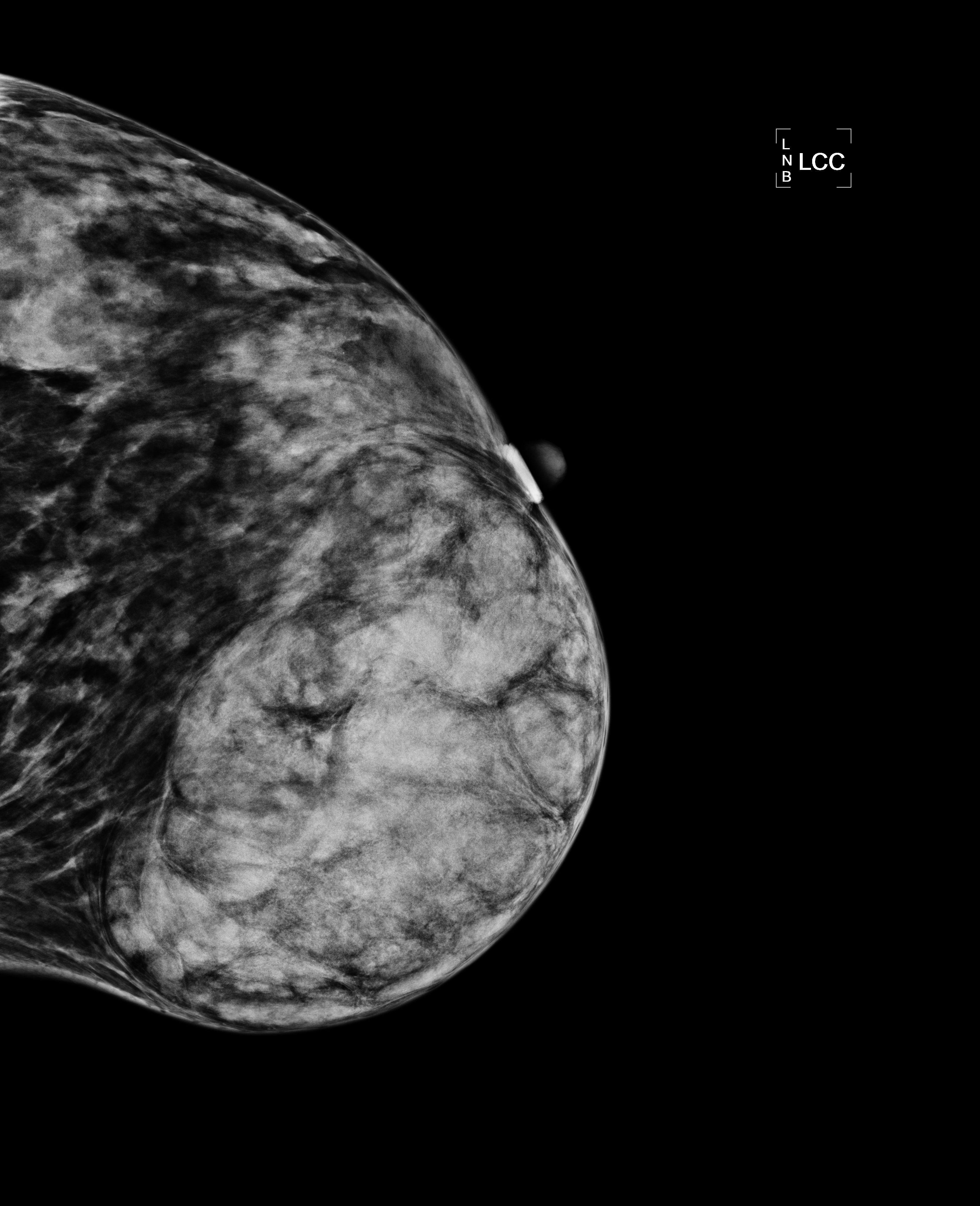 Image IQ: 37-year-old Female with Markedly Asymmetric Breasts