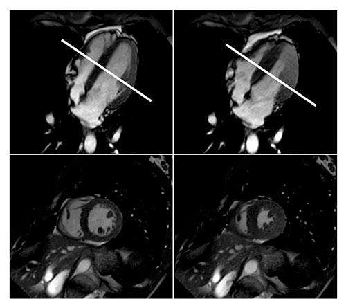 3D Fused CT/MRI Images Improve Coronary Artery Disease Diagnosis