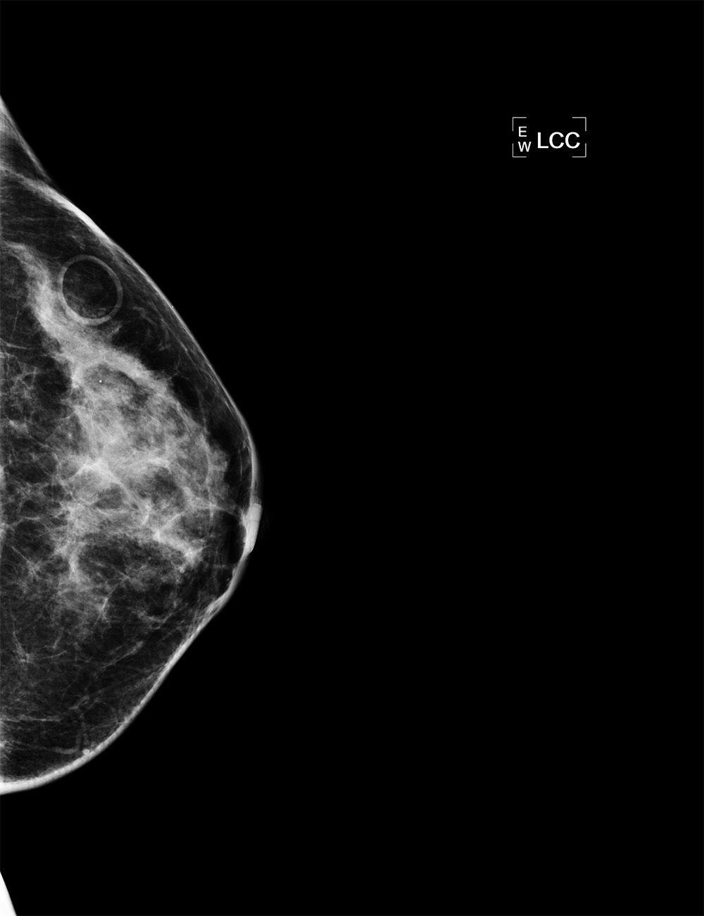 Image IQ: 52-year-old Female with Family History of Breast Cancer