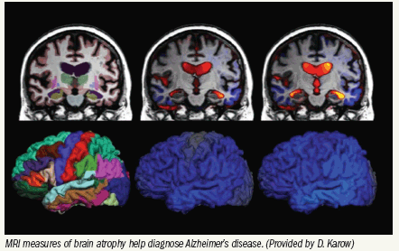 Volumetric MRI produces earlywarning on Alzheimer's disease